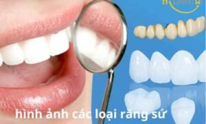 các loại răng sứ tốt nhất hiện nay
