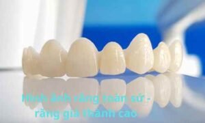 hình ảnh răng toàn sứ giá thành cao