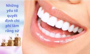 chi phí làm răng sứ toàn sứ