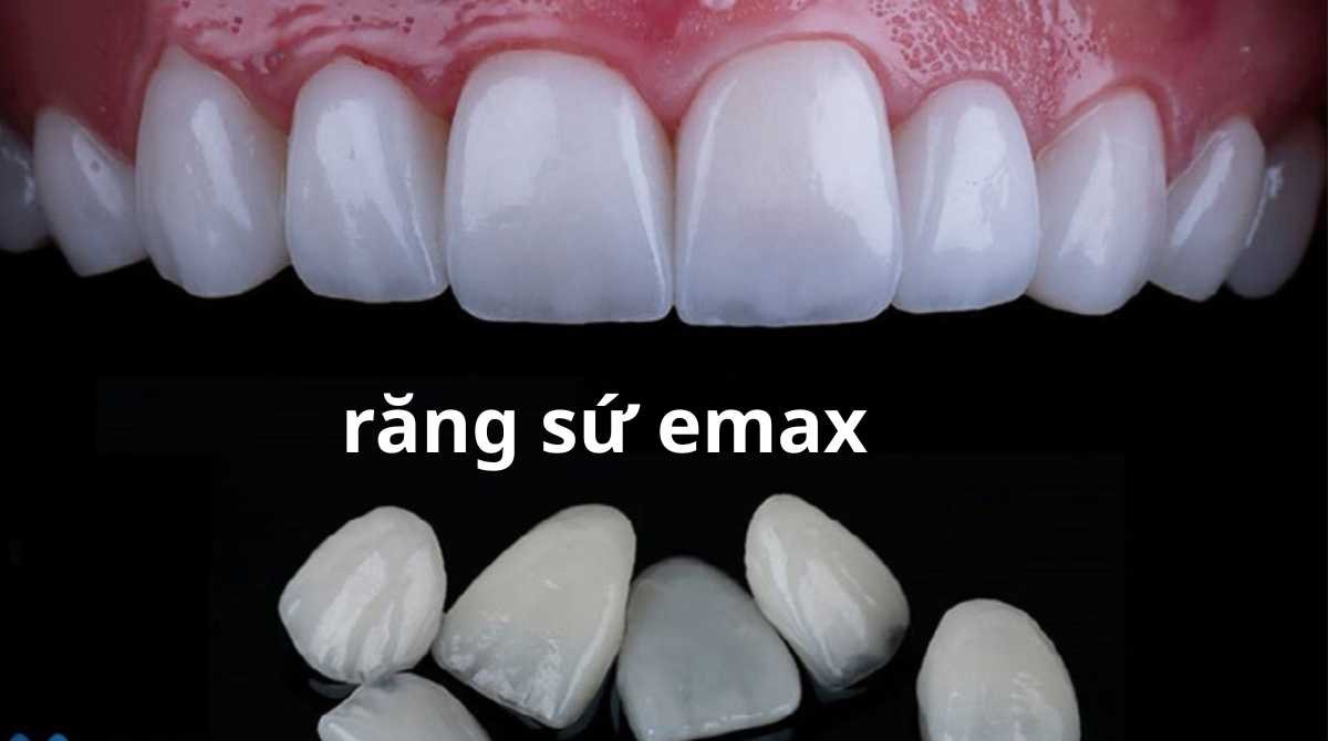 top các loại răng sứ tốt nhất